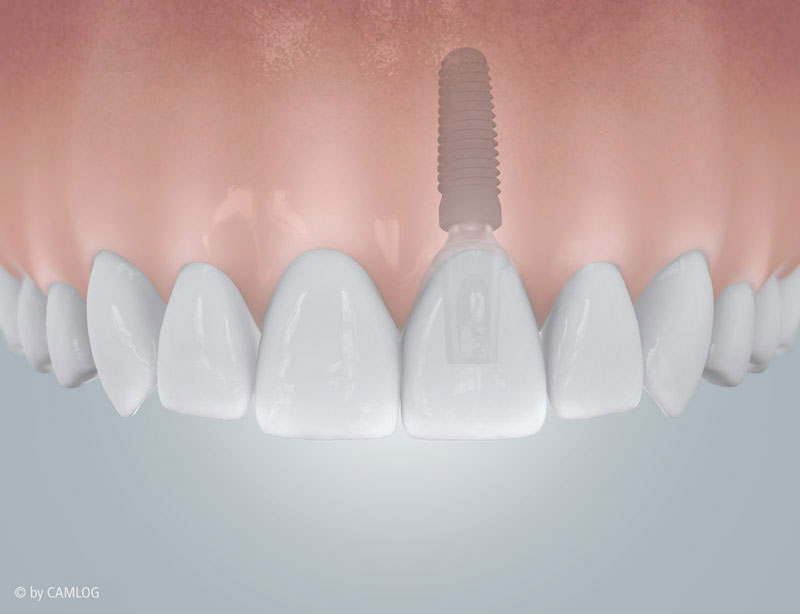 Einzelnes Implantat mit Krone