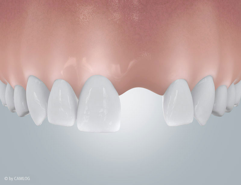 Einzellücke im Kiefer