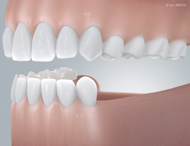 Nach hinten offene Zahnlücke