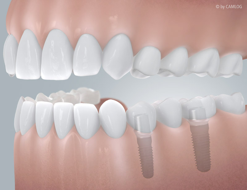 Brücke auf Implantaten