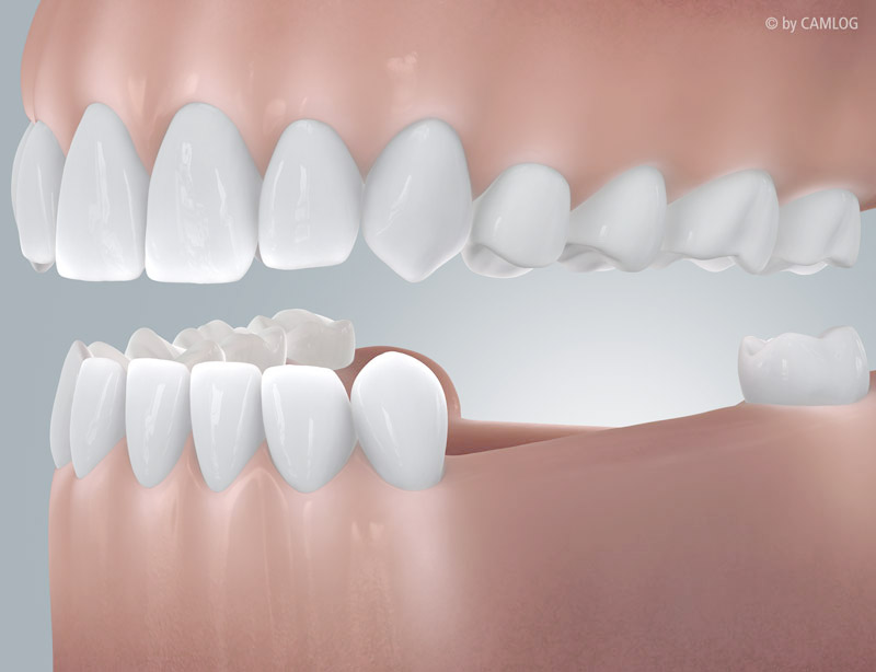 Beidseits begrenzte Zahnlücke