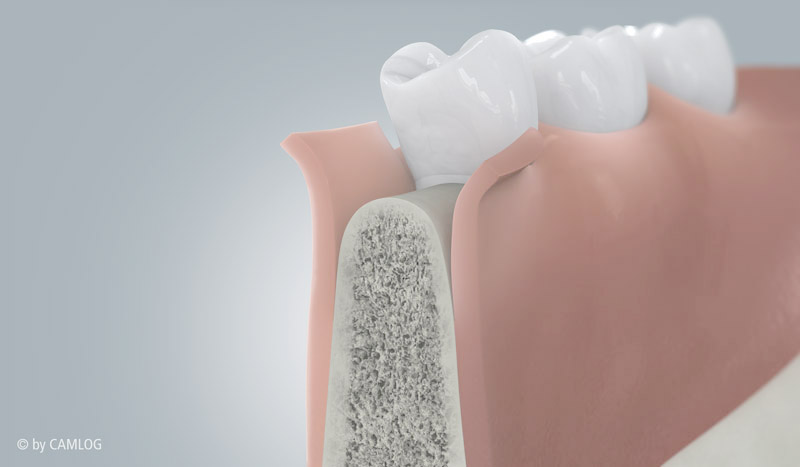 Aufklappen von Zahnfleisch