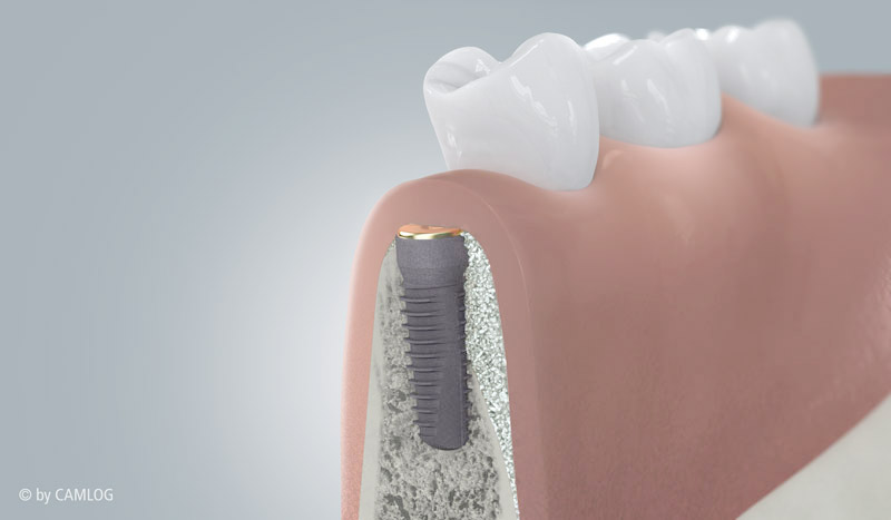 Einheilung des Implantats