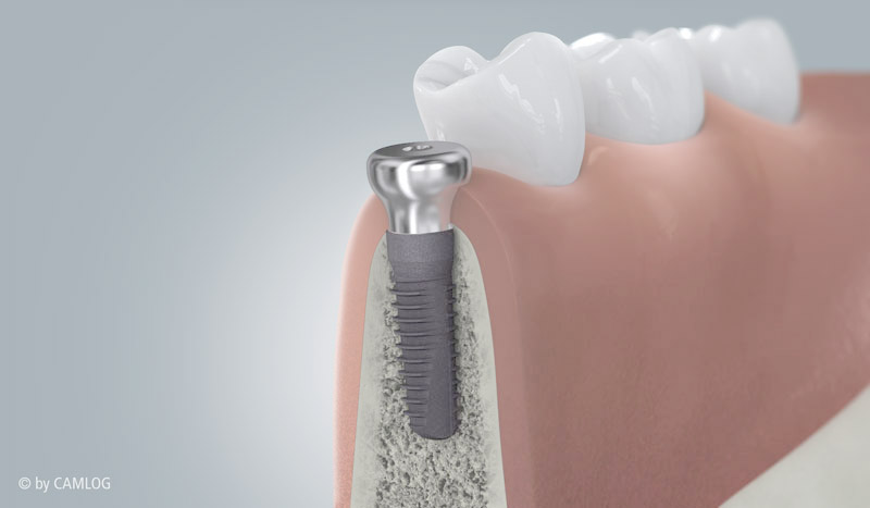 Zahnfleischausformung