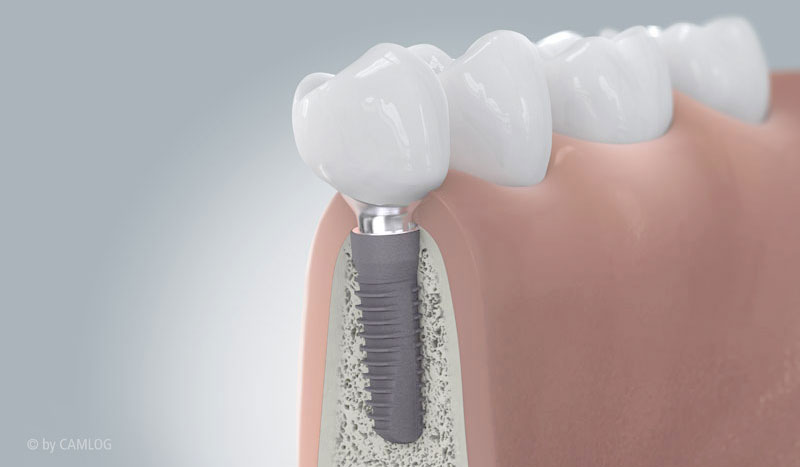 Zahnkrone auf dem Implantat