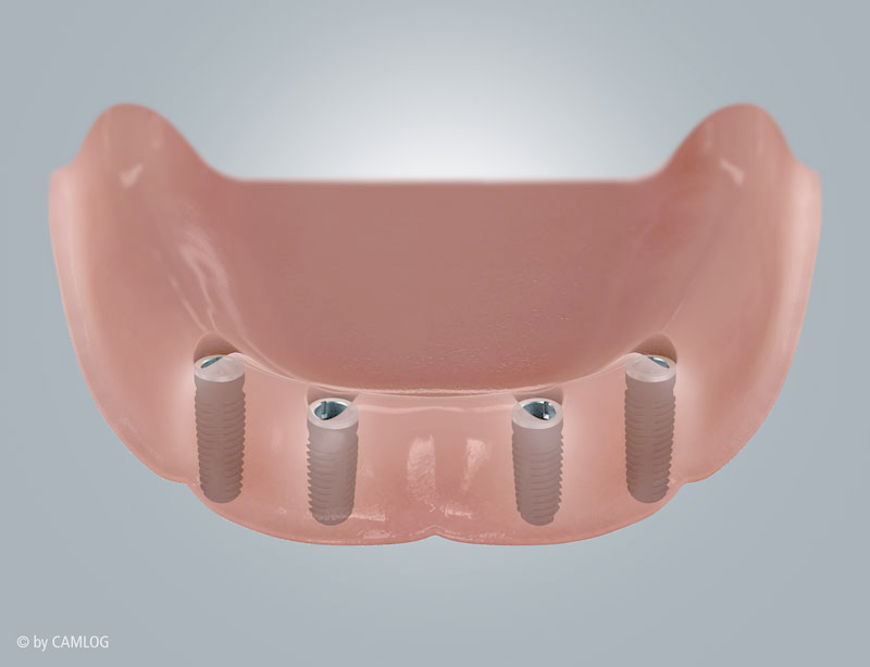 Implantate im Kiefer
