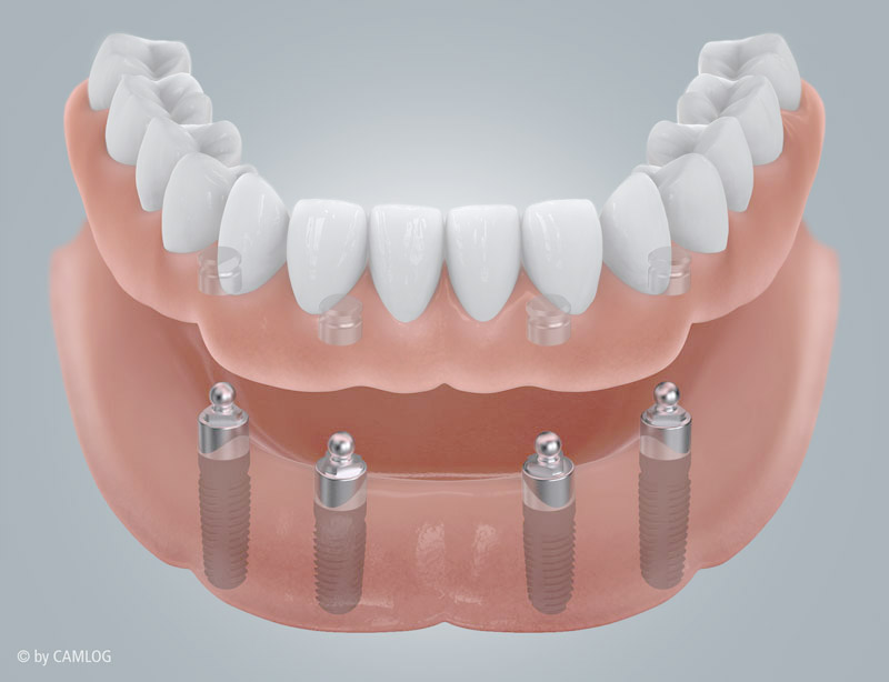Kugelknopf-Implantate