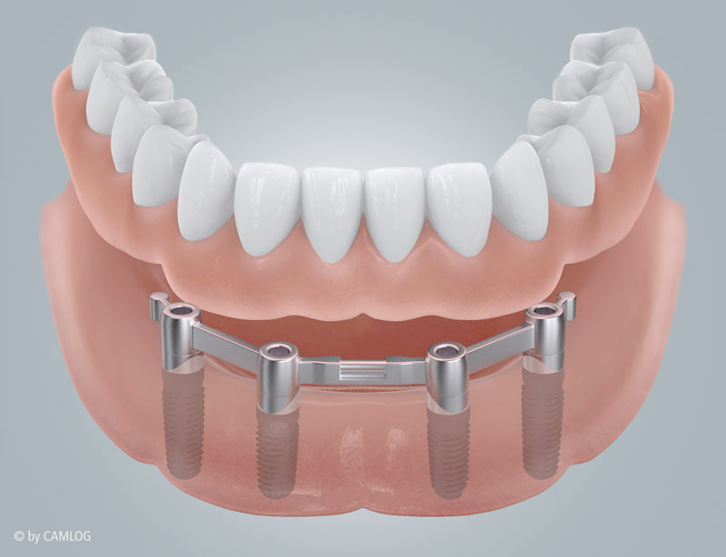 Steg-Implantatprothese