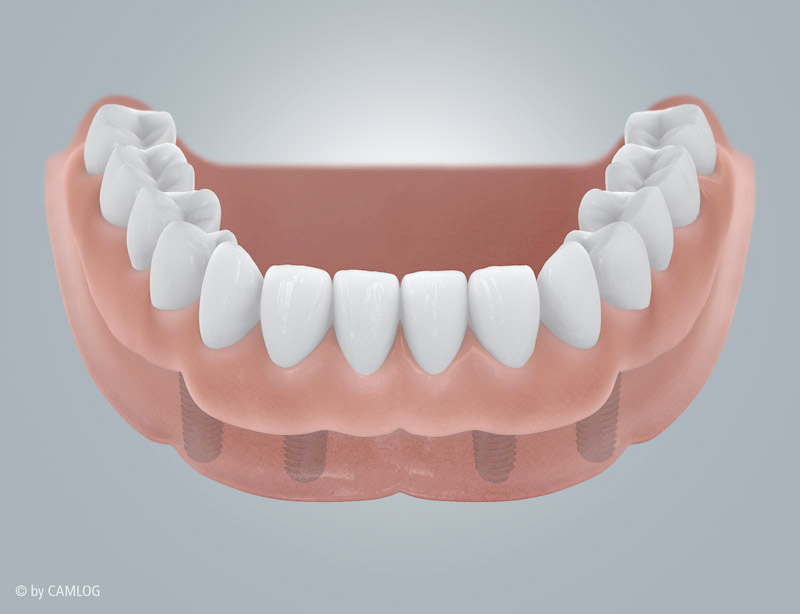 Implantat-verankerter Zahnersatz